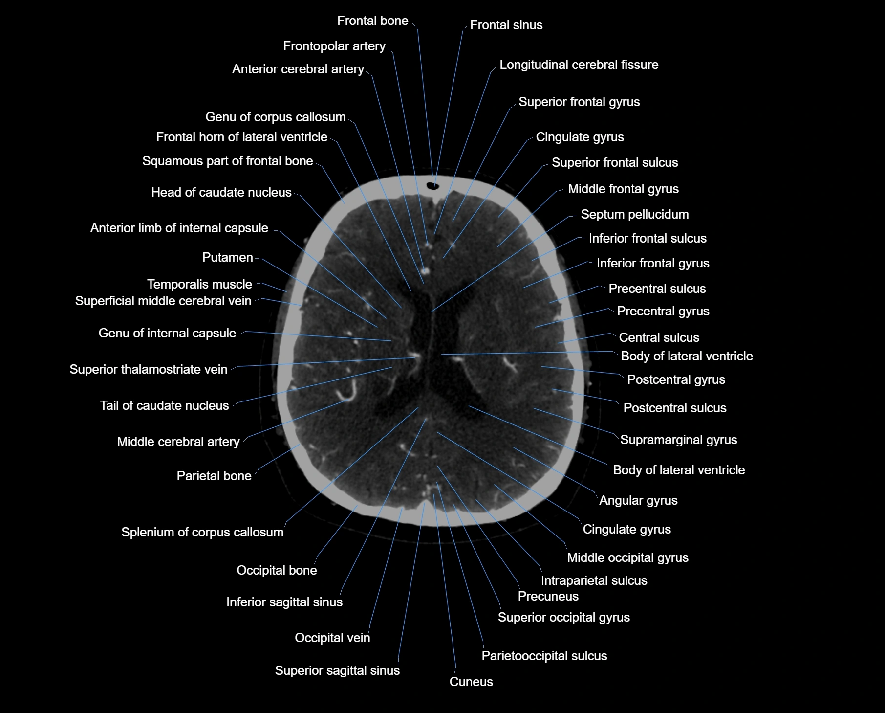 CT scan brain axial labelled cross sectional anatomy image-img-000043.webp